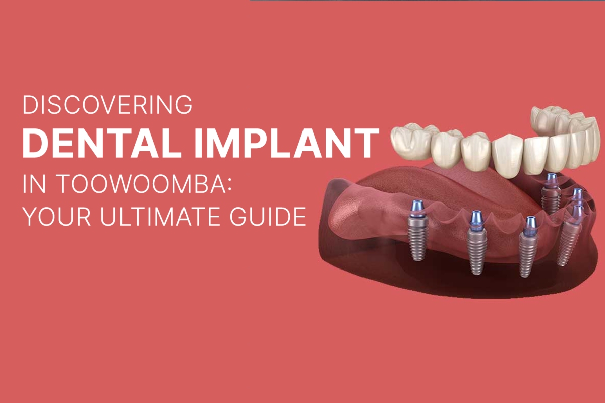 Discovering Dental Implants in Toowoomba: Your Ultimate Guide